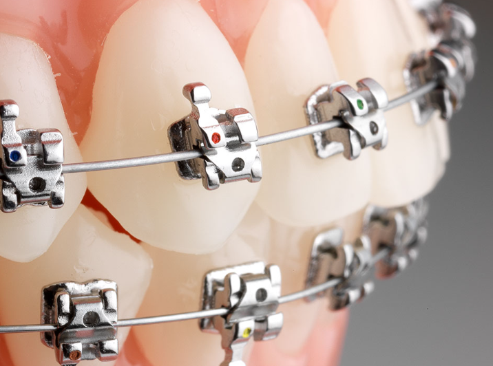 Orthodontic Brackets Orthodontic Brackets